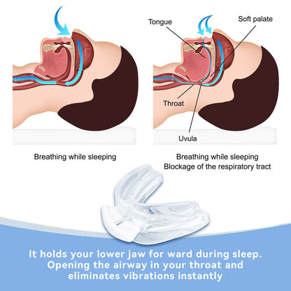 Adjustable Anti-Snoring Mouth Guard for Sleep